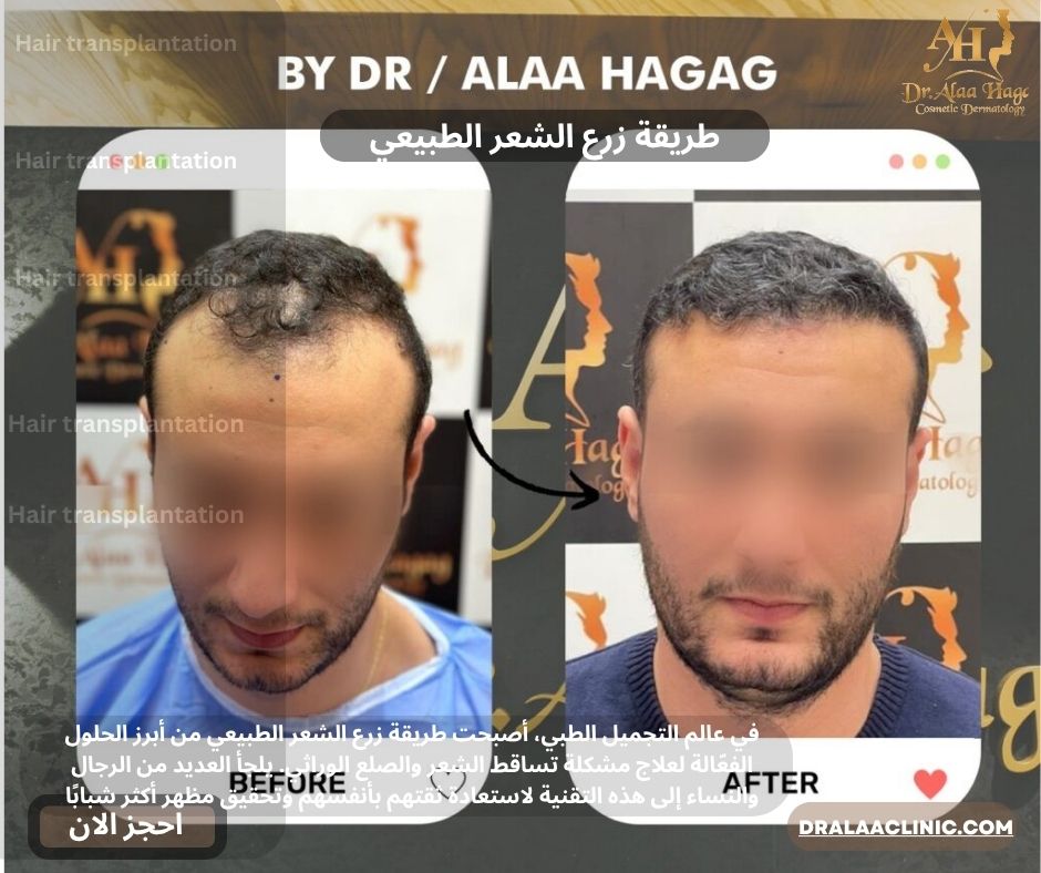 طريقة زرع الشعر الطبيعي