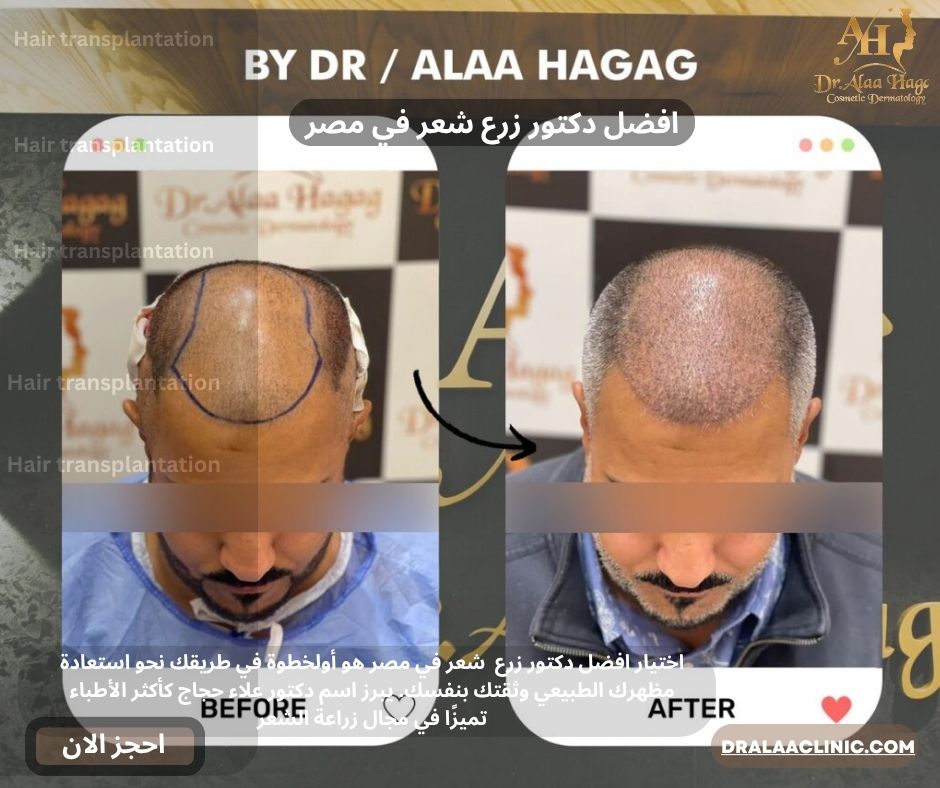 افضل دكتور زرع شعر في مصر