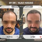 طرق علاج فراغات الشعر