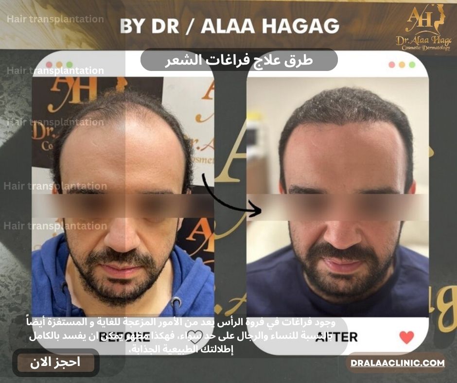طرق علاج فراغات الشعر