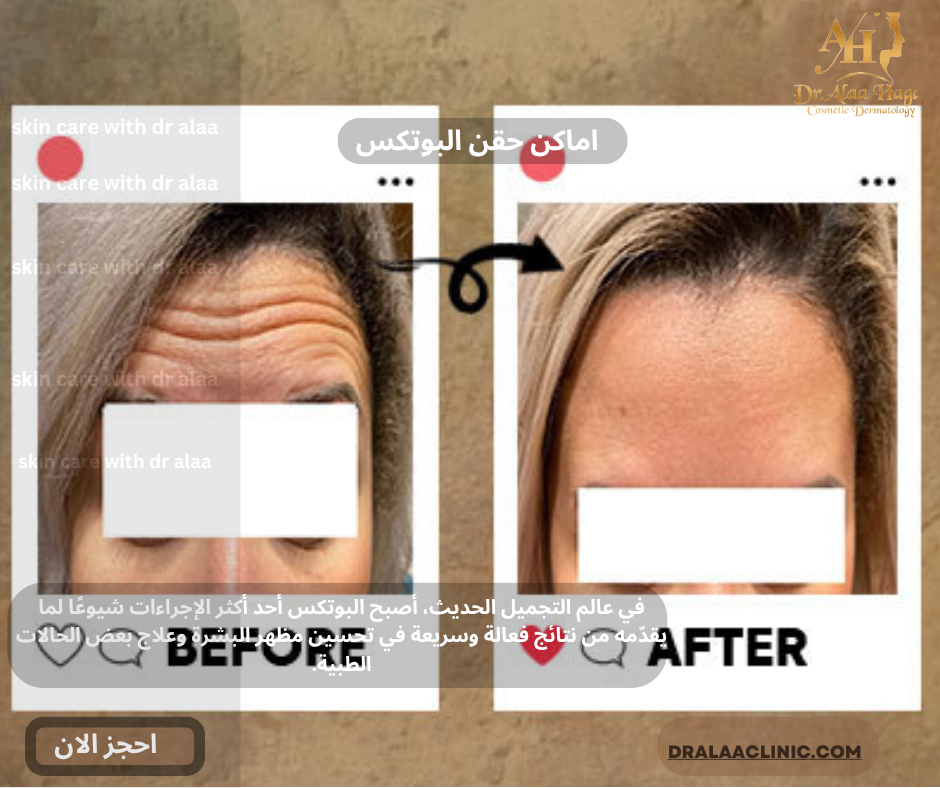 اماكن حقن البوتكس