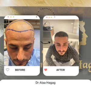 زراعة الشعر بالاقتطاف