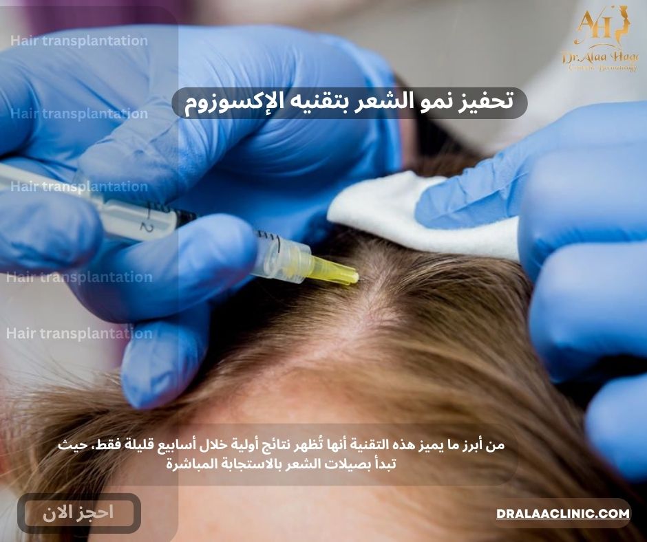 تحفيز نمو الشعر بتقنيه الإكسوزوم