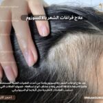 علاج فراغات الشعر بالاكسوزوم