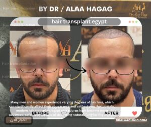 hair transplant egypt
