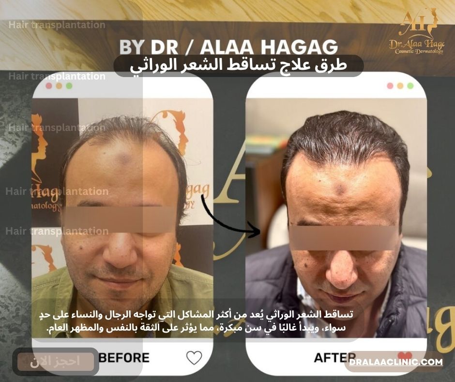 طرق علاج تساقط الشعر الوراثي