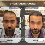 احسن دكتور متخصص في علاج الشعر