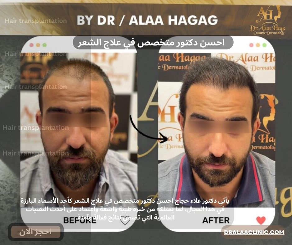 احسن دكتور متخصص في علاج الشعر