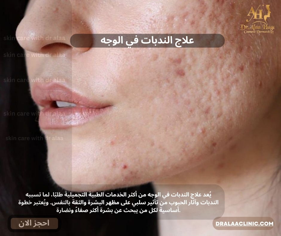 علاج الندبات في الوجه