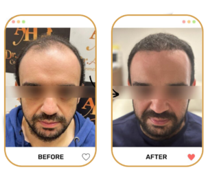 تجربتي مع زراعة الشعر بالاقتطاف بجهاز ZEUS الأمريكي