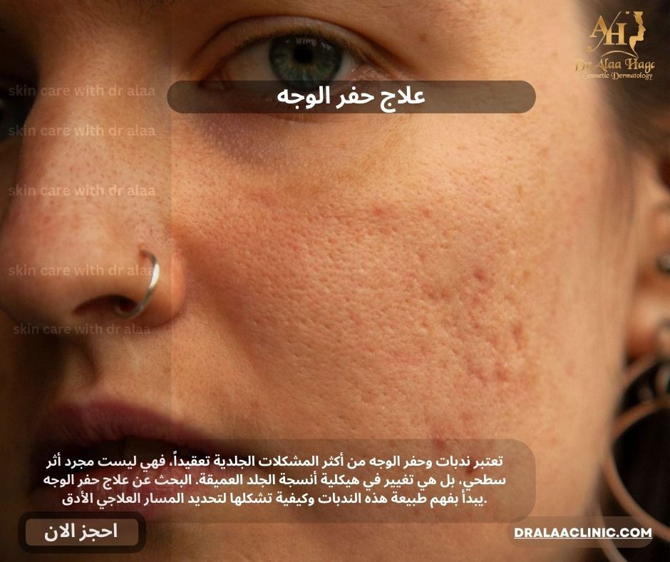 علاج حفر الوجه