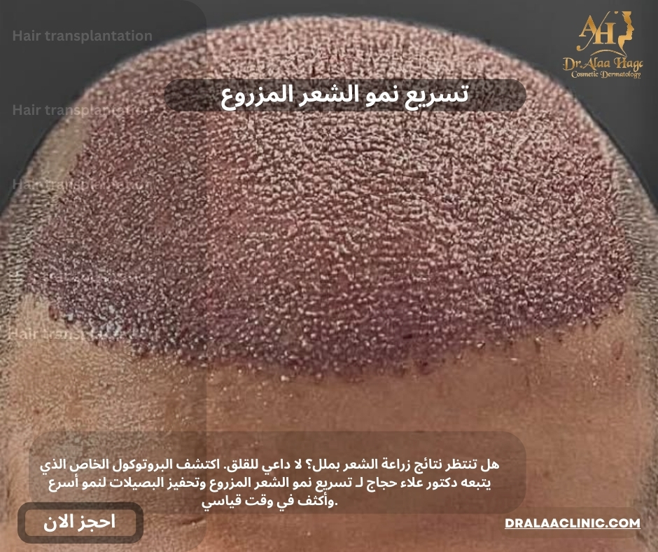 تسريع نمو الشعر المزروع