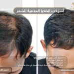 امبولات الخلايا الجذعية للشعر من مركز د.علاء حجاج