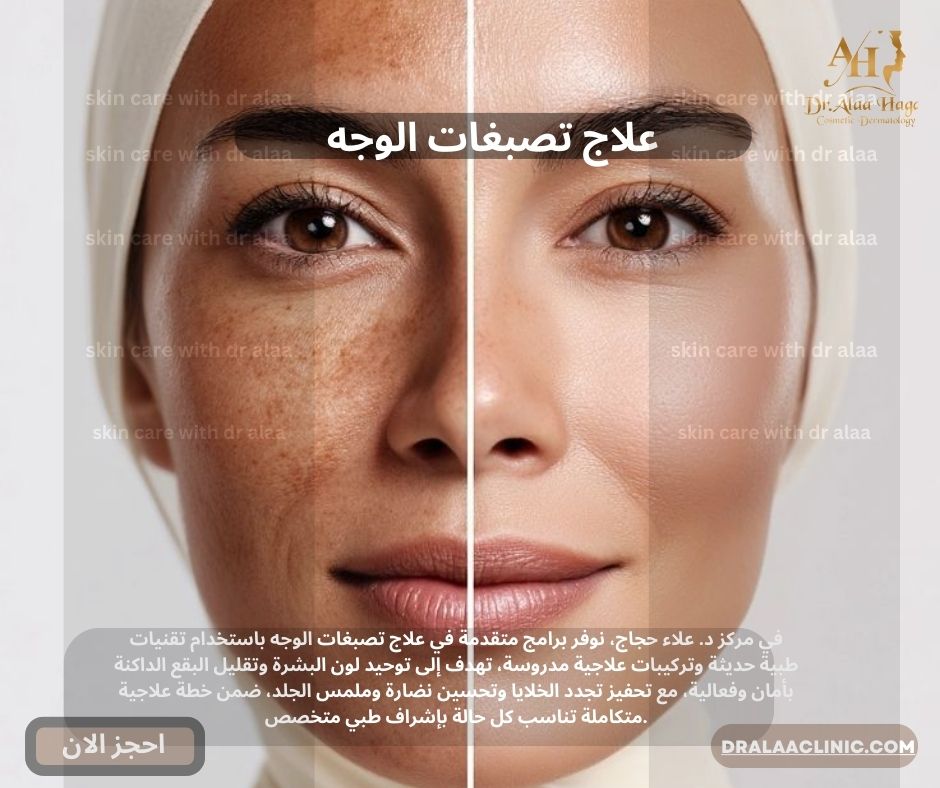 علاج تصبغات الوجه في مركز د.علاء حجاج