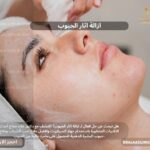 ازالة اثار الحبوب