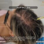 بديل زراعة االشعر