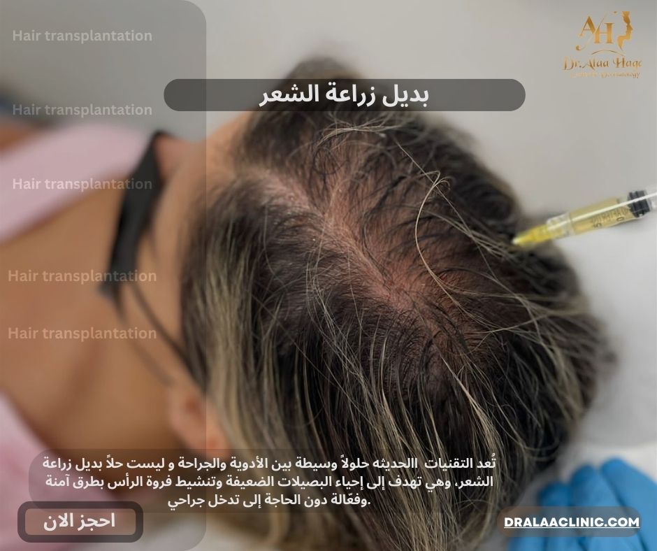 بديل زراعة االشعر