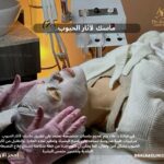 ماسك لاثار الحبوب