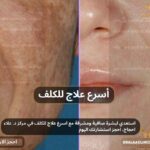 اسرع علاج للكلف بمركز د.علاء حجاج