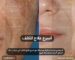 اسرع علاج للكلف بمركز د.علاء حجاج