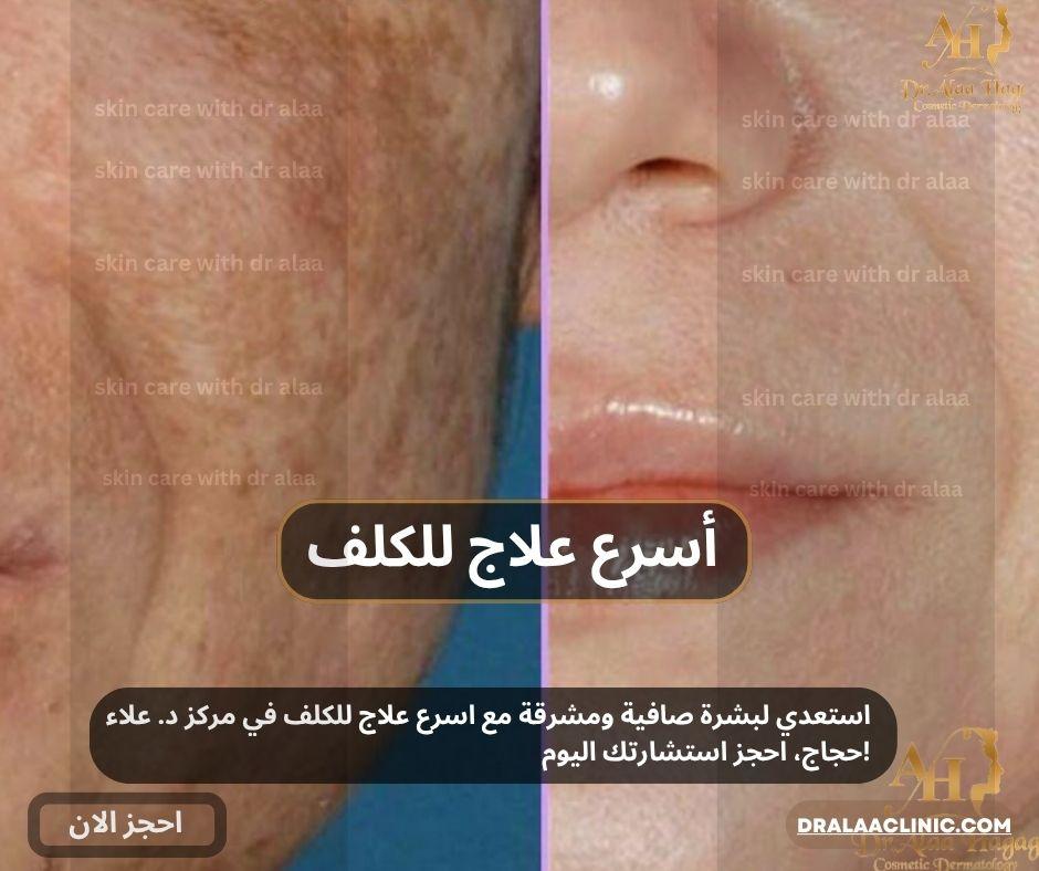 اسرع علاج للكلف بمركز د.علاء حجاج