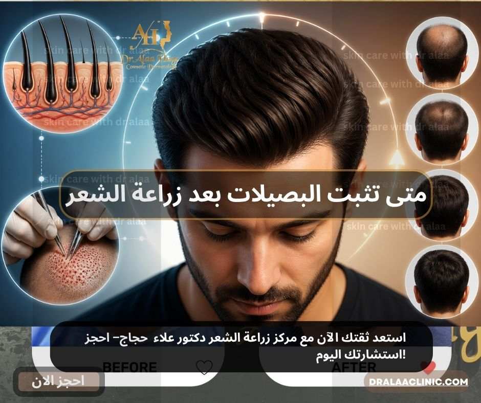 متى تثبت البصيلات بعد زراعة الشعر الجدول الزمني من د.علاء حجاج