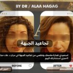 تجاعيد الجبهة