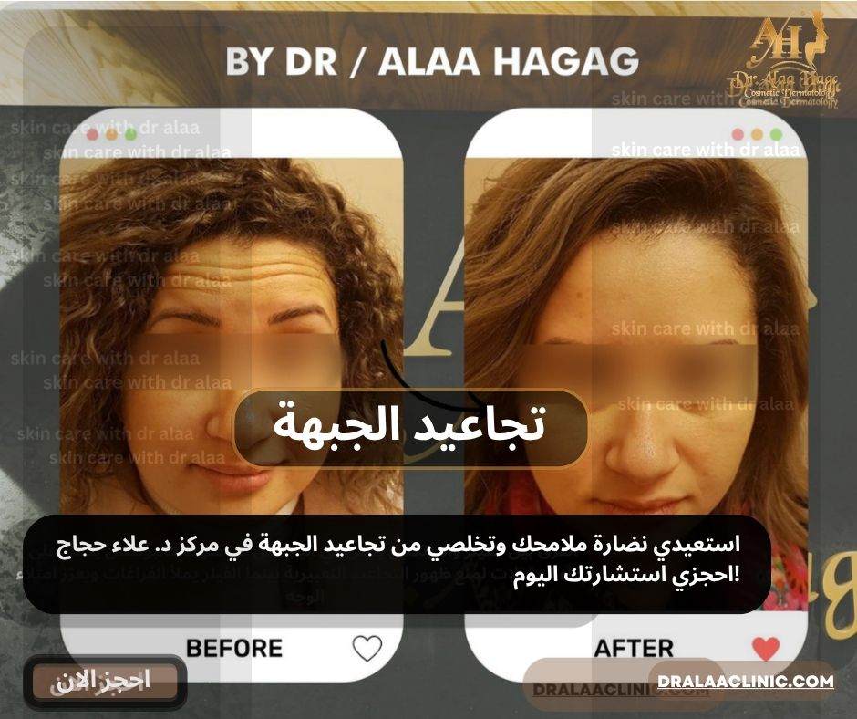 تجاعيد الجبهة