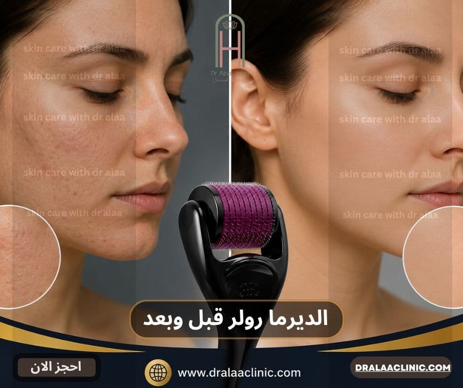الديرما رولر قبل وبعد