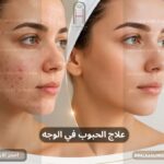 علاج الحبوب في الوجه