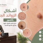 أشكال الزوائد الجلدية بالصور 2026: الدليل الطبي الكامل لتمييز الآمن من الخطير مع د. علاء حجاج