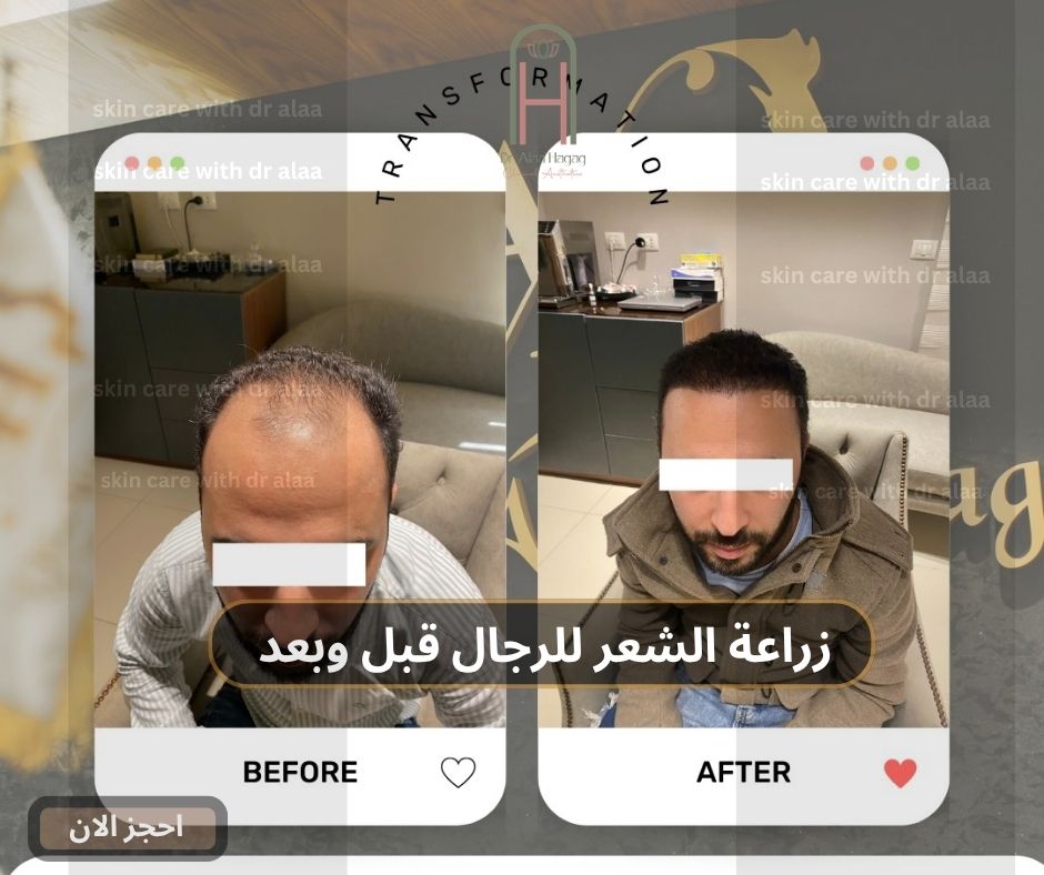 زراعة الشعر للرجال قبل وبعد