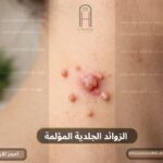 الزوائد الجلدية المؤلمة