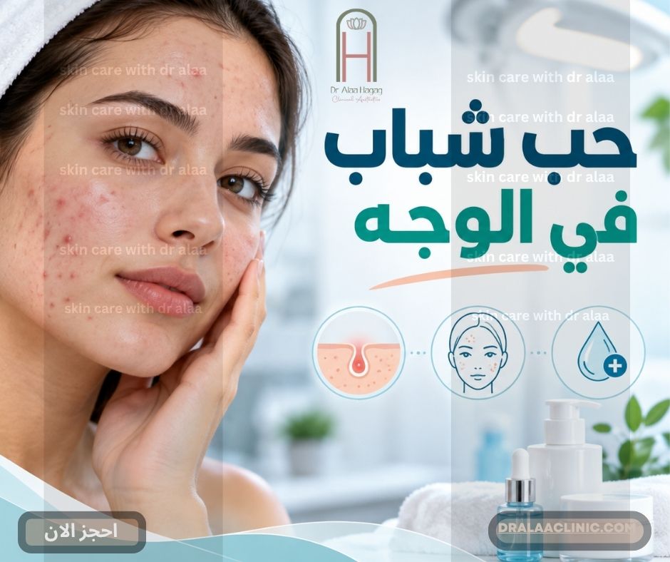 حب شباب في الوجه