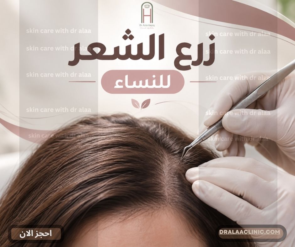زرع الشعر للنساء
