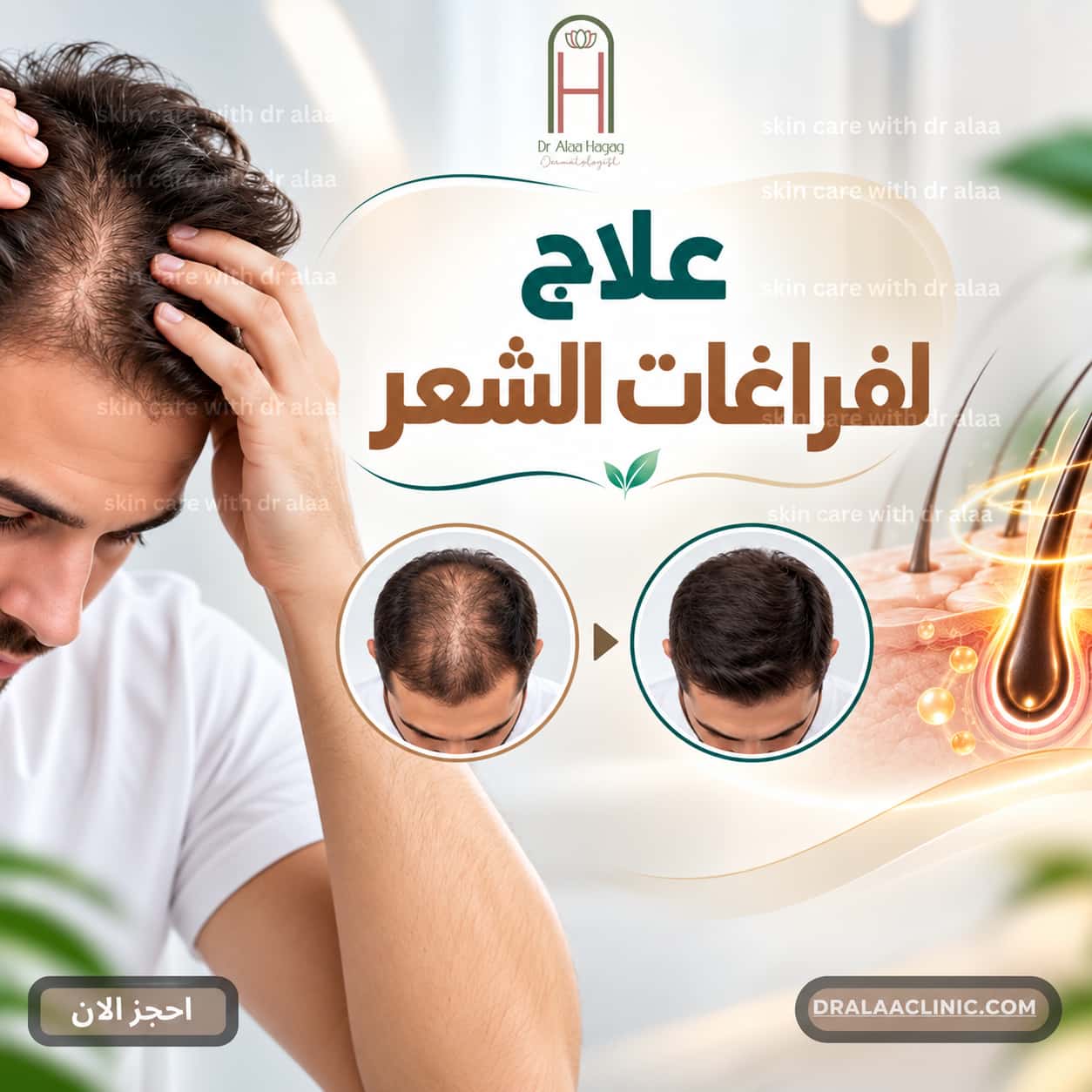 علاج لفراغات الشعر​